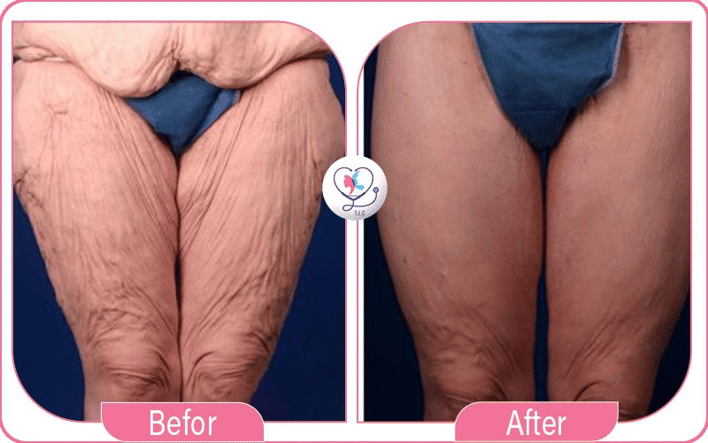 نتائج شد ترهلات الفخذين بعد 3 و6 أشهر