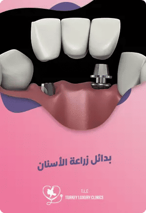 بدائل زراعة الأسنانfeatured image