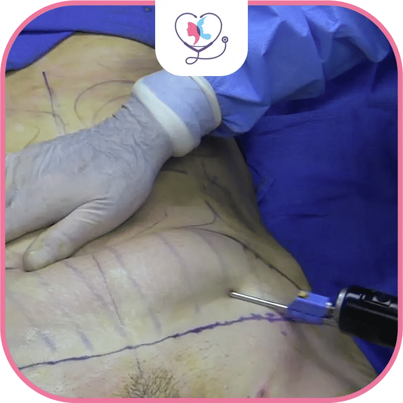 ما هو شفط الدهون التقليدي؟