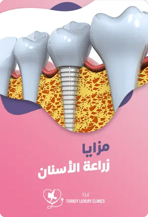 مزايا زراعة الأسنانfeatured image