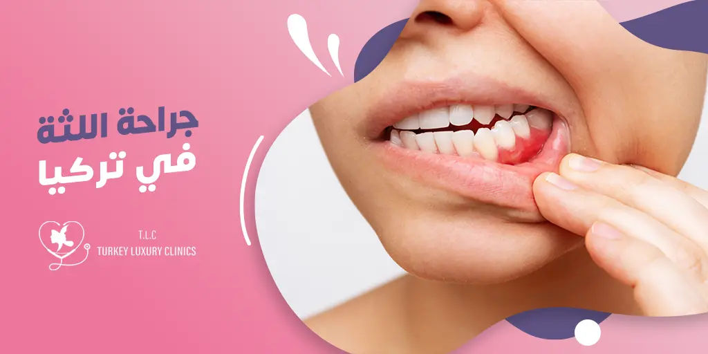 جراحة اللثة في تركيا: الأنواع والتكلفة