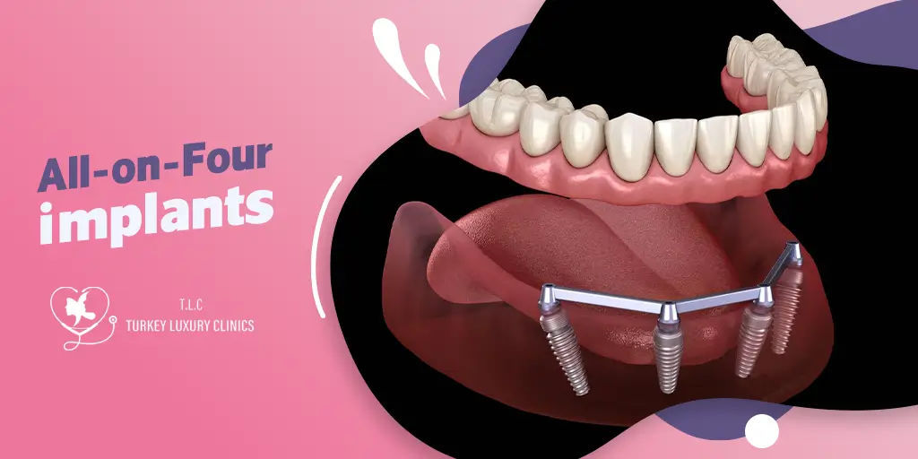 All-on-4 Implantate in der Türkei: Erschwingliche Lösung