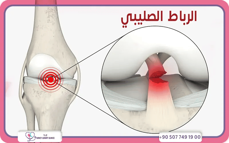العوامل المؤثرة على تكلفة عملية الرباط الصليبي