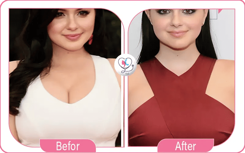 Why Did Ariel Winter Get a Breast Reduction?