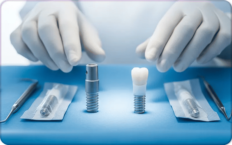 Factors Affecting All on 4 Dental Implant Cost