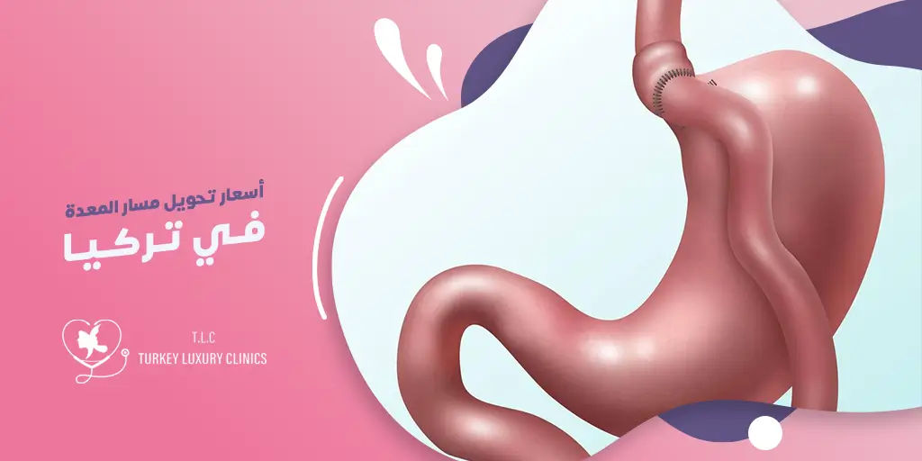تكلفة عملية تحويل مسار المعدة في تركيا