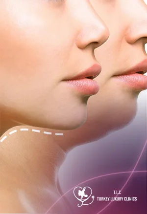 Double Chin Surgery Before and After: Results & Photos