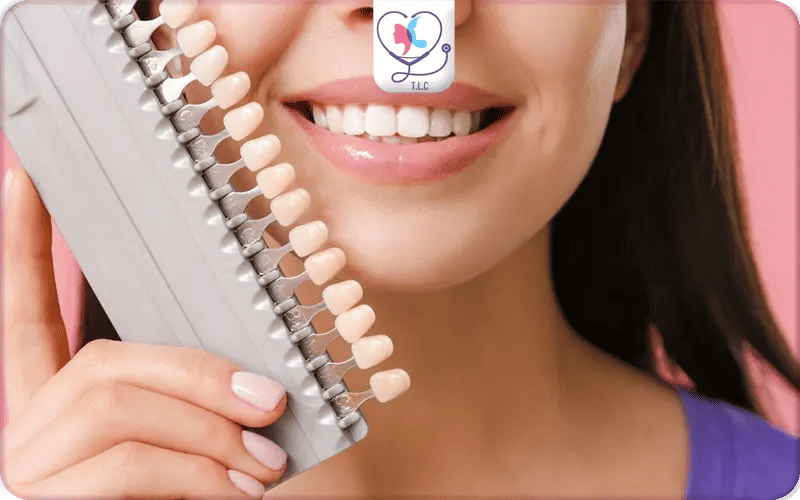What Are Emax Veneers?