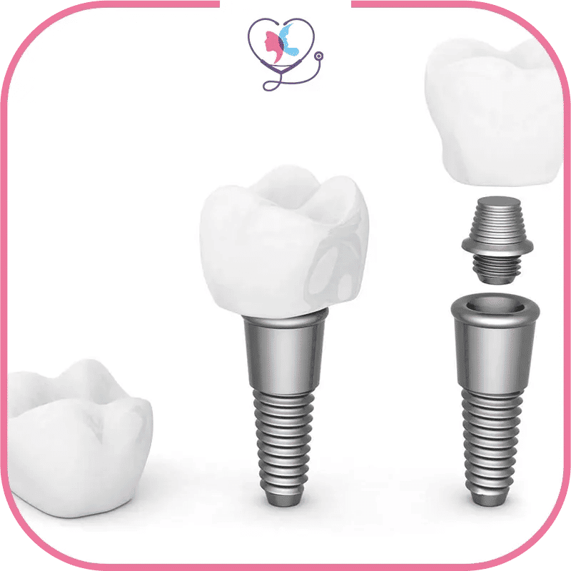 types-d'implants-dentaires-image-1772041623555