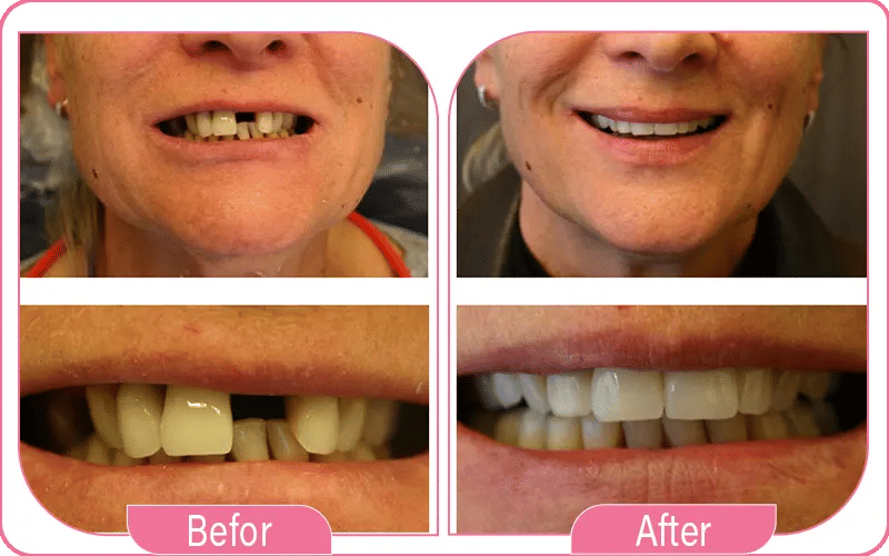 Single Tooth Dental Implant Before and After 2