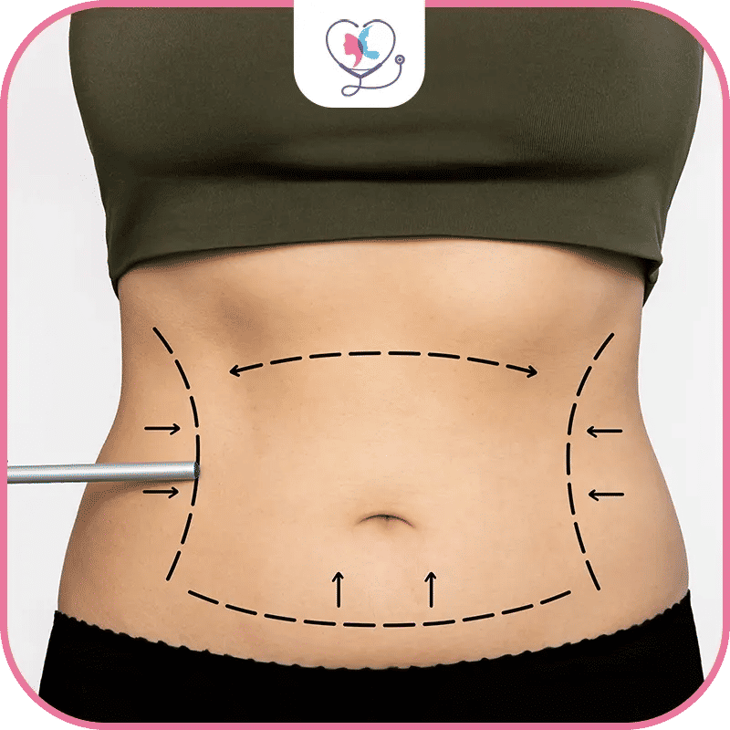 liposuccion ventre turquie - liposuccion ventre turquie tarif