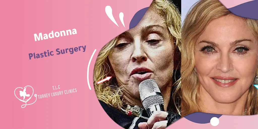 Madonna Schönheitschirurgie: Gerüchte, Vorher-Nachher & 2025