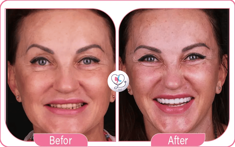 How does Veneers Procedure Work?