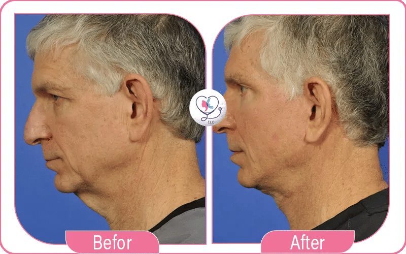 What is Turkey Neck?