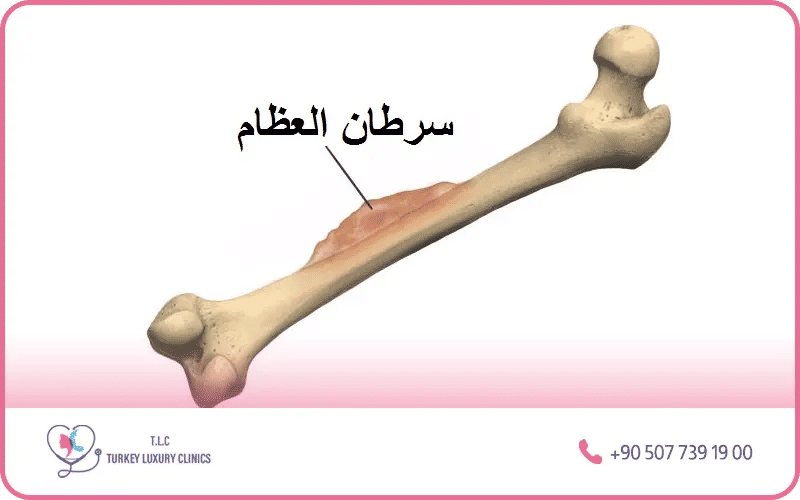 ما هو سرطان العظام؟