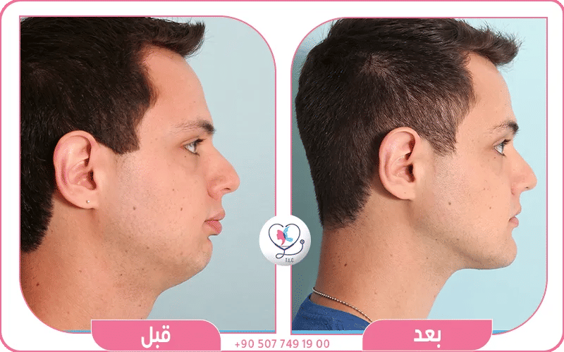 شفط دهون الخد قبل وبعد