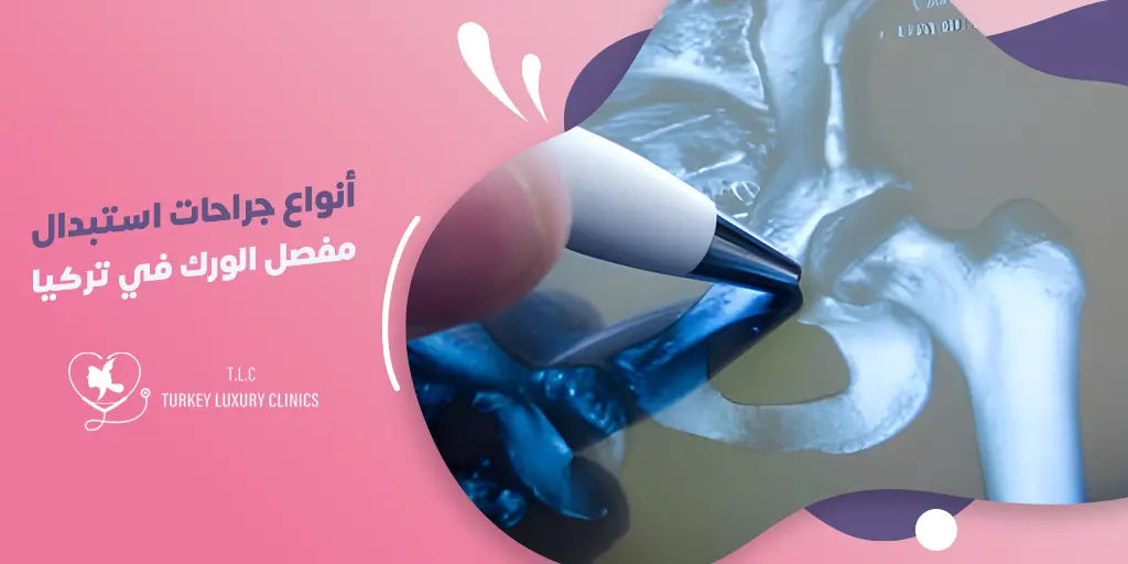 أنواع جراحة استبدال مفصل الورك في تركيا