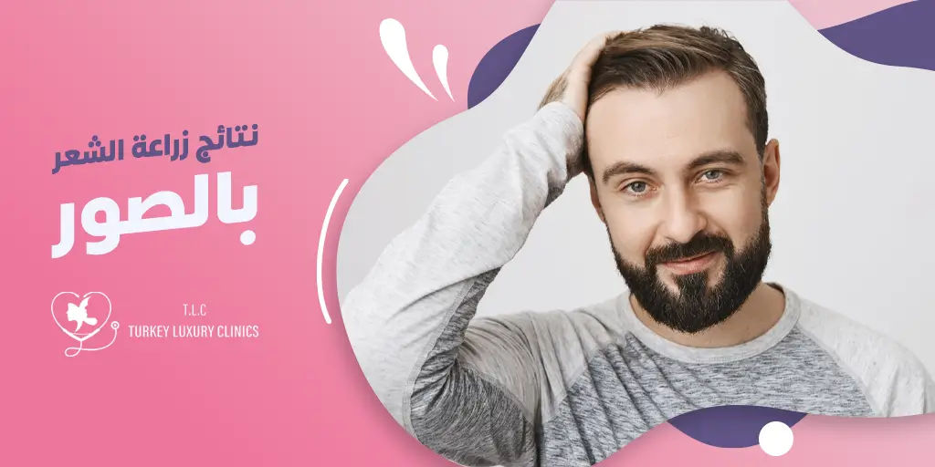 نتائج زراعة الشعر بالصور