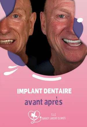 Implant dentaire avant après