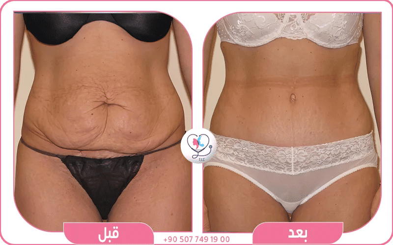 معاناتي مع الكرش بعد القيصرية