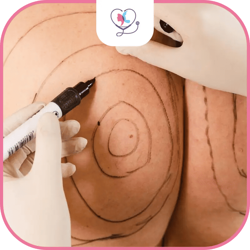 خطوات عملية شد الظهر