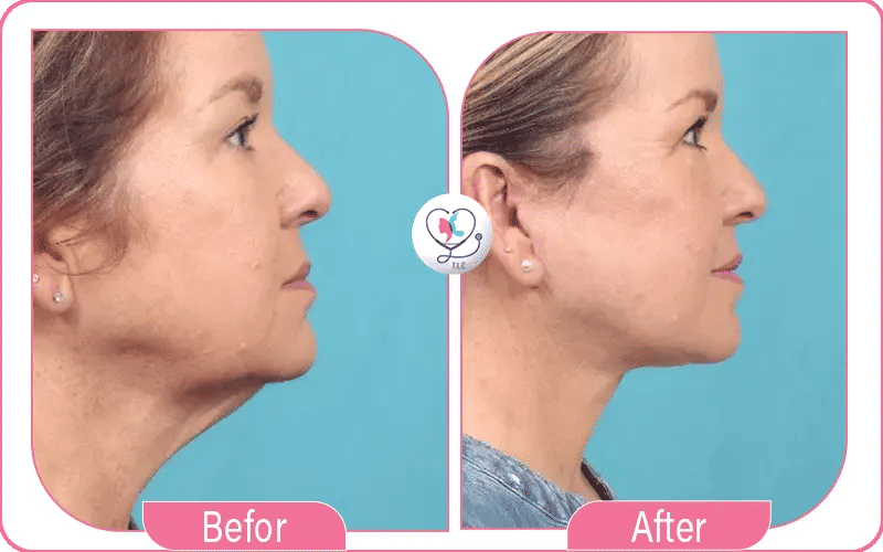 Mini Face and Neck Lift Before and After