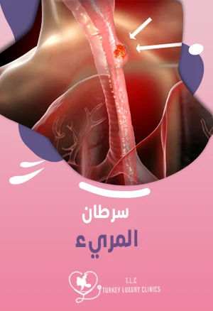 سرطان المريء: كيف ينشأ وما هي أنواعه وطرق العلاج؟