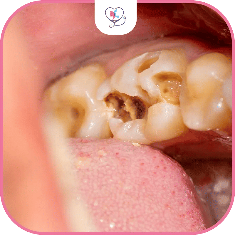 quelles-sont-les-causes-des-dents-manquantes-?