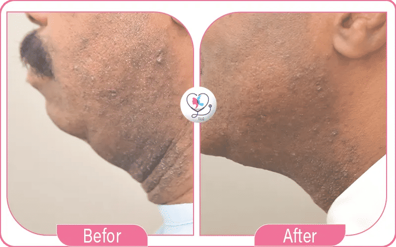 تجربتي مع شفط اللغلوغ