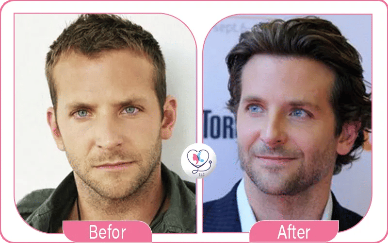 Bradley Cooper et la greffes de cheveux