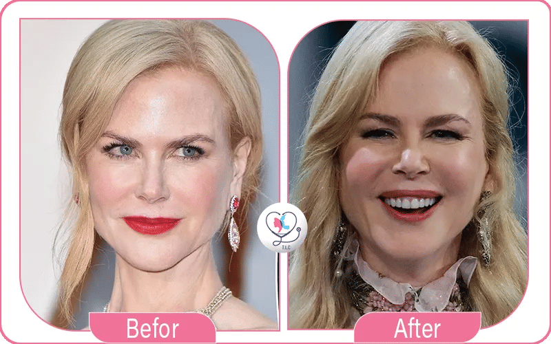 Nicole Kidman Facelift
