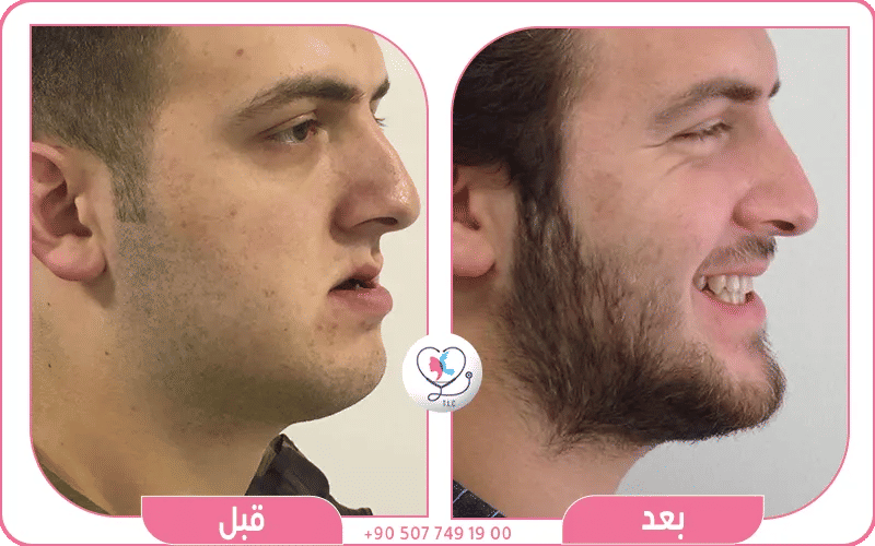عملية تقديم الذقن أو الذقن المنزلق أو رأب العظم