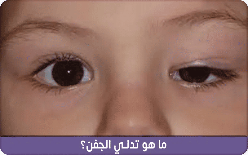 ما هو تدلي الجفن؟