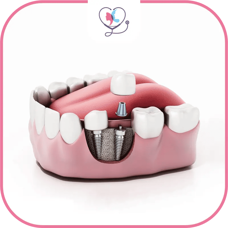 implant dentaire en turquie