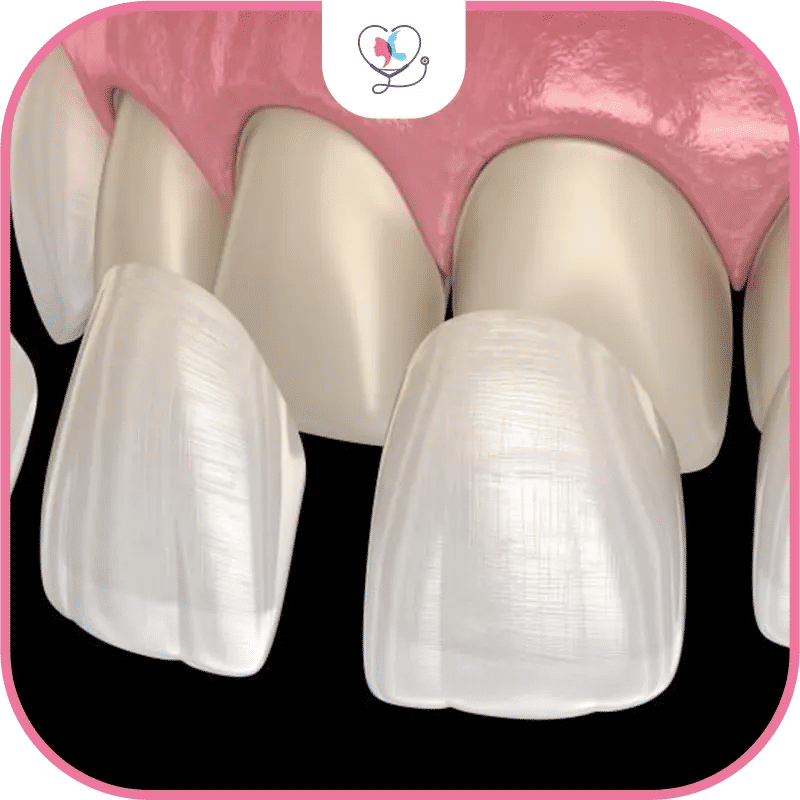 ما هي ابتسامة هوليود الدائمة؟