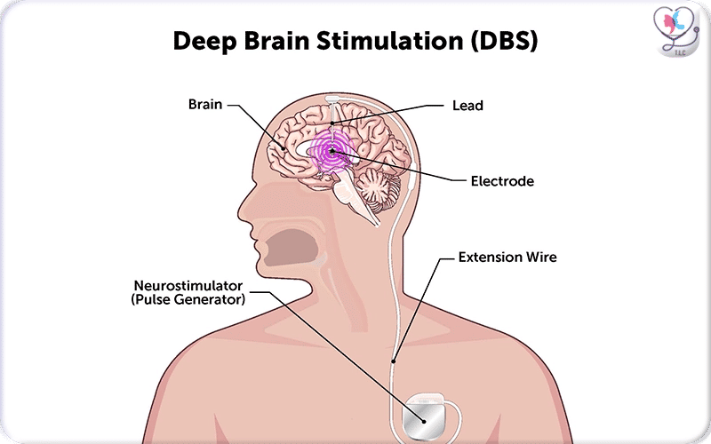 What is Deep Brain Stimulation Surgery?