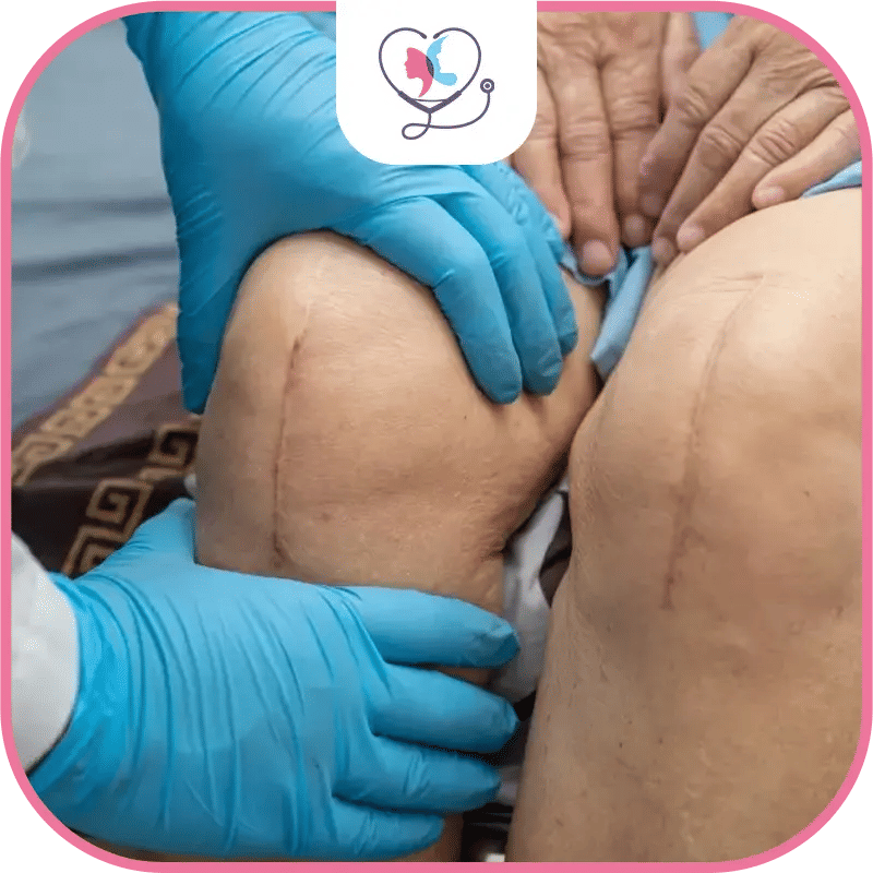 Same day Bilateral Knee Replacement 