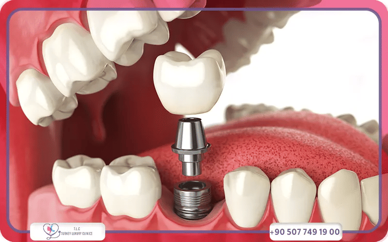 Prix des implants dentaires