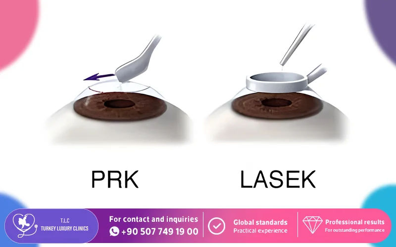 What Is LASEK vs PRK?