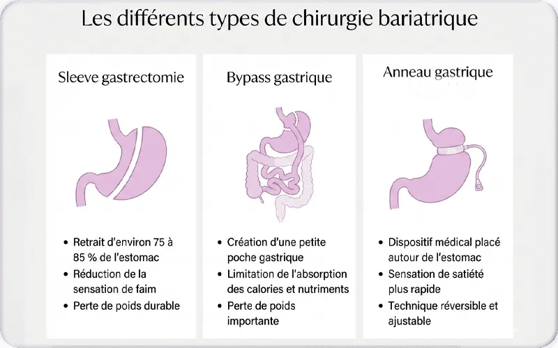Les différents types de chirurgie bariatrique
