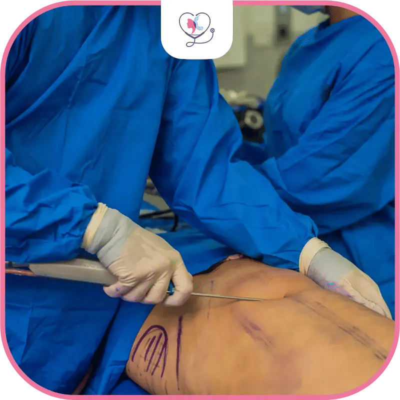 ما الفرق بين شفط الدهون وشد البطن؟