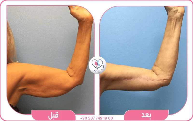 سعر عملية شد الزنود