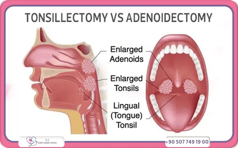 Tonsillectomy vs Adenoidectomy