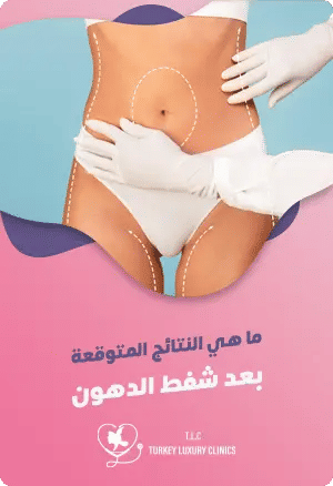 ماهي نتائج شفط الدهون المتوقعة؟featured image