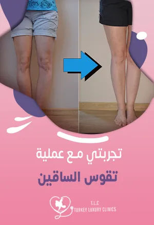 تجربتي مع عملية تقوس الساقين: نسب النجاح أكثر من 90%