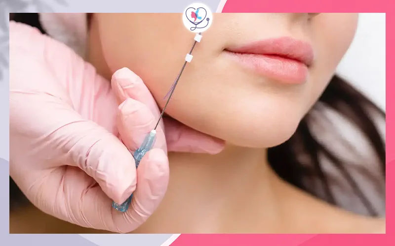Thread Lift in Turkey Are you a good candidate