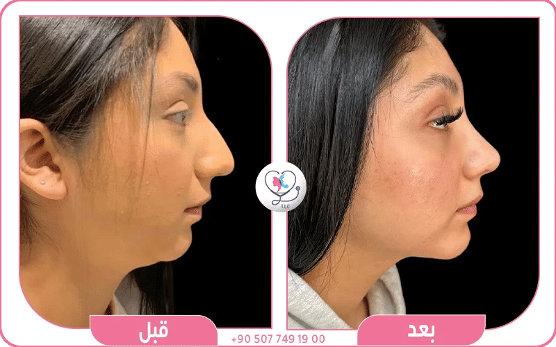 خطوات عملية شفط دهون الوجه