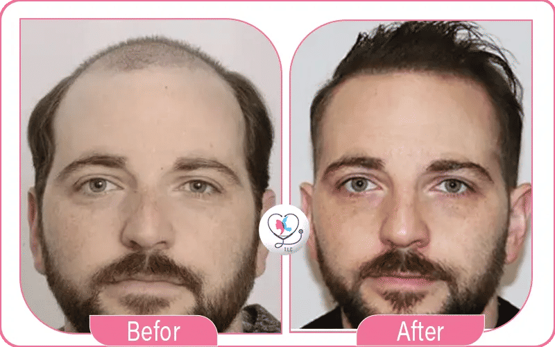 أنواع الإكسوزومات المشتقة من الخلايا الجذعية أنواع الإكسوزومات المشتقة من الخلايا الجذعية