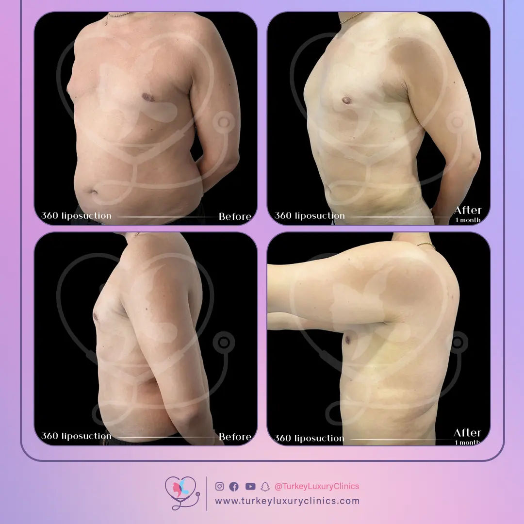 مزايا إجراء عملية شفط الدهون في تركيا لاكشري كلينك