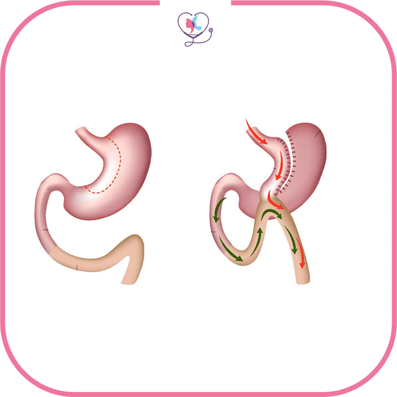 ما هي أسباب إجراء عملية تحويل المسار المصغر بعد التكميم؟
